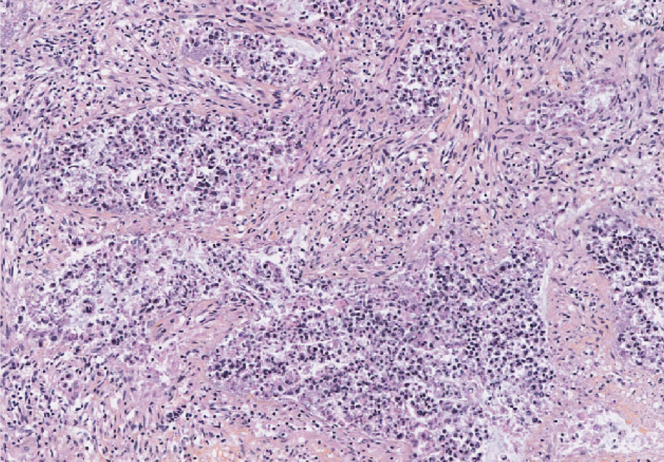 2-day CRC fragment under aCD3 treatment