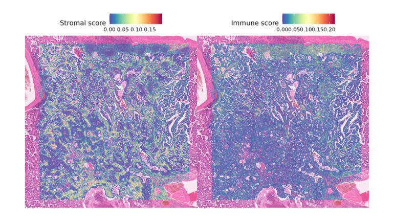 Bioinformatics Analysis of Visium HD Spatial Transcriptomics Datasets