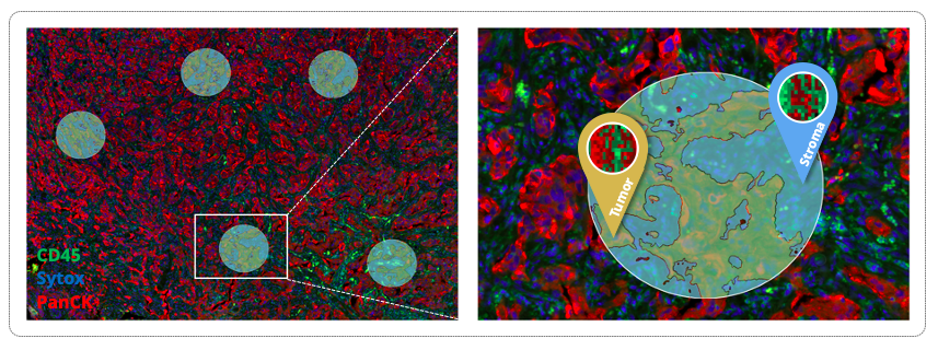 FFPE tissue section from human lung cancer analyzed with GeoMx