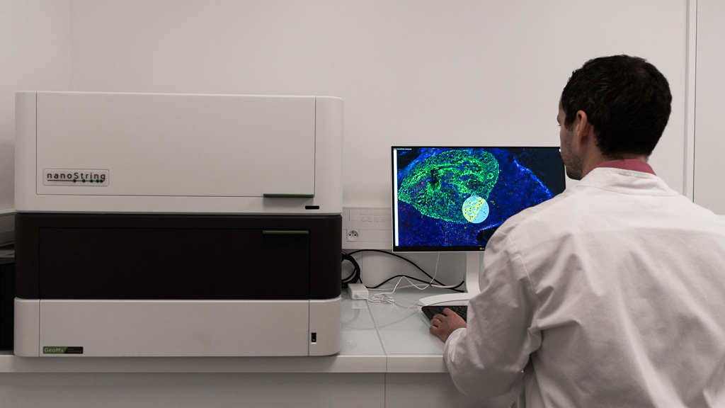 GeoMx DSP analysis of tumor and stromal compartments in pre-treatment NSCLC samples