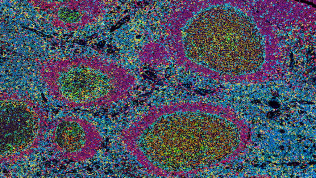B Cells and Tertiary Lymphoid Structures as Key Players in Anti-Tumor Immune Response
