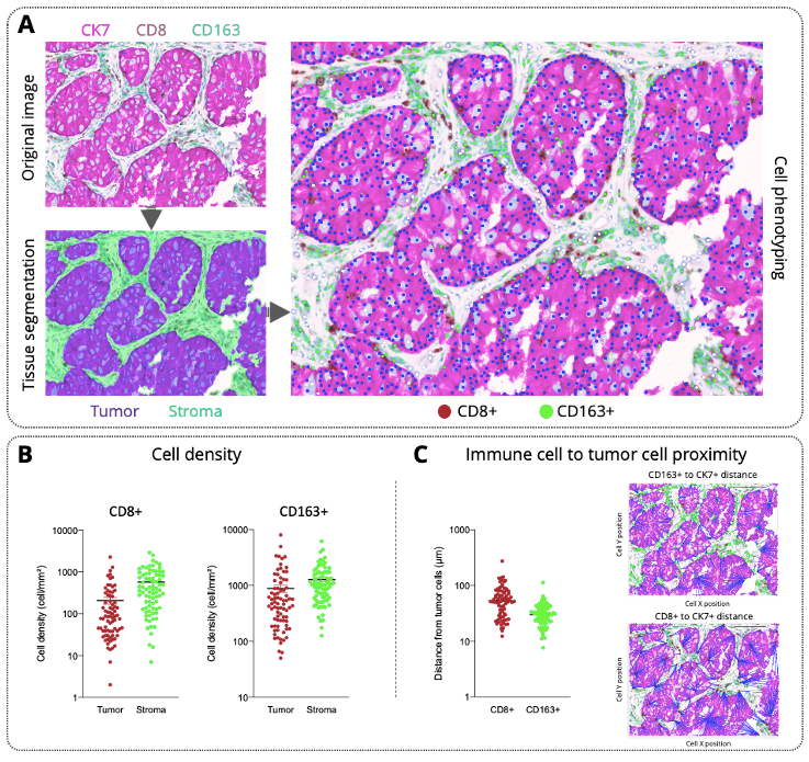 Multiplexed immunohistochemistry imaging for immune contexture analysis in human lung adenocarcinomas.