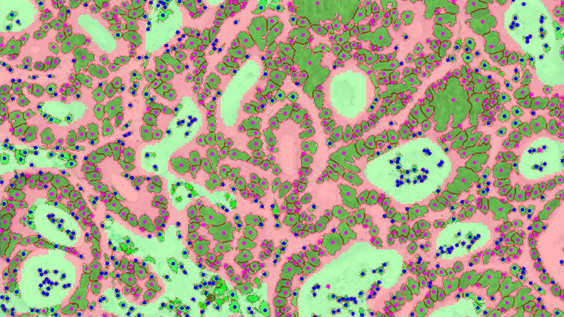 Quantitative histology to characterize immune contexture in human lung adenocarcinoma samples