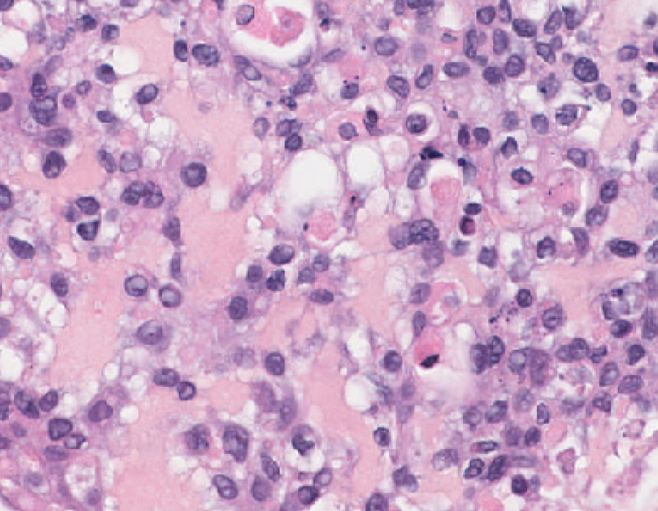 TNBC patient tumor