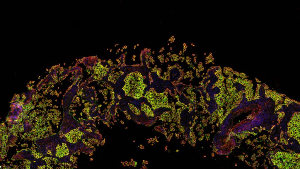 TROP2: A Strong Predictor of Resistance to Immunotherapy in Lung Cancer