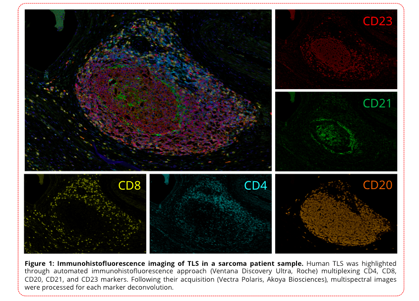 immunohistofluorescence imaging of TLS in a sarcoma patient sample