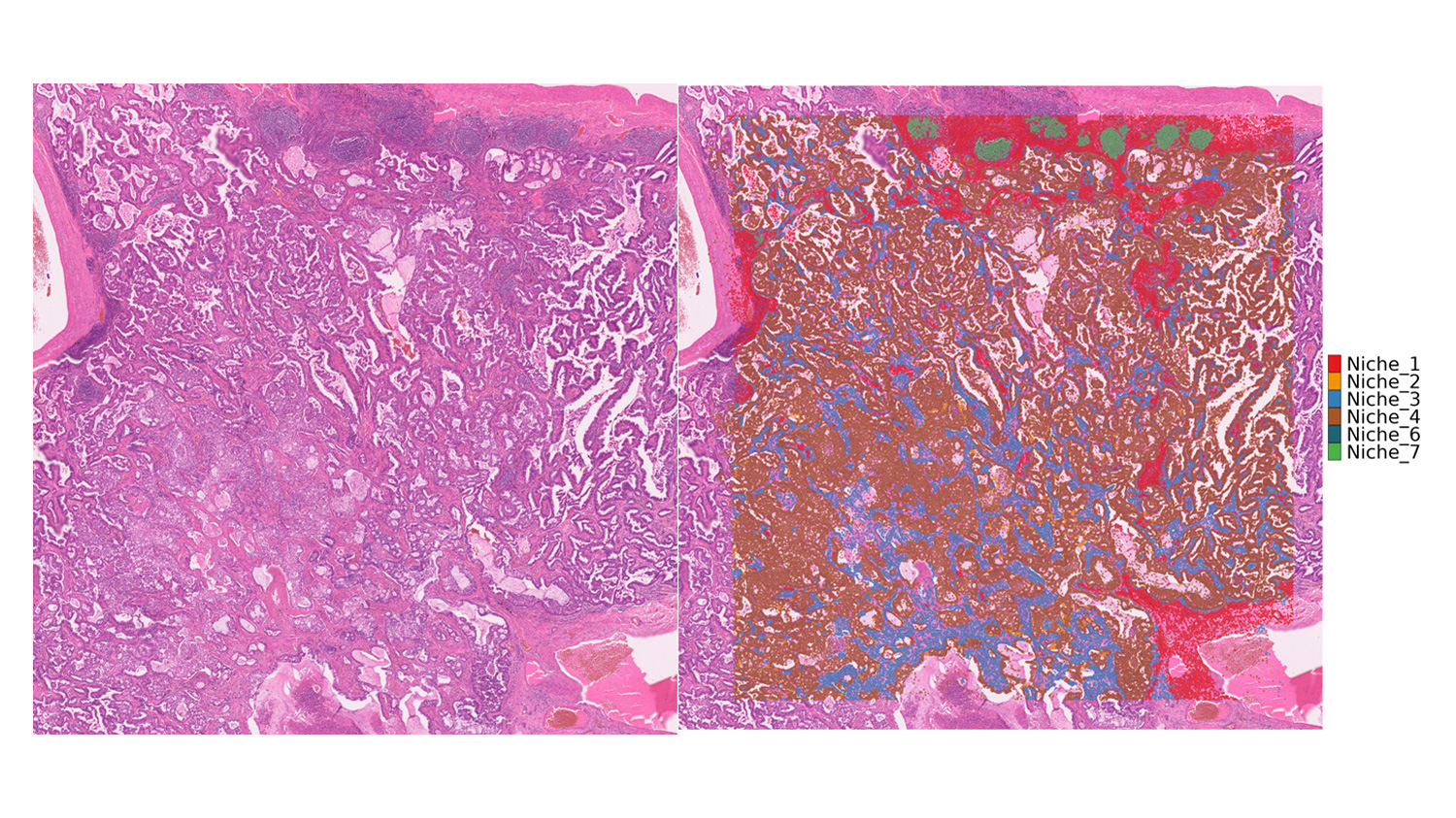 Bioinformatics analysis of Visium HD spatial transcriptomics data