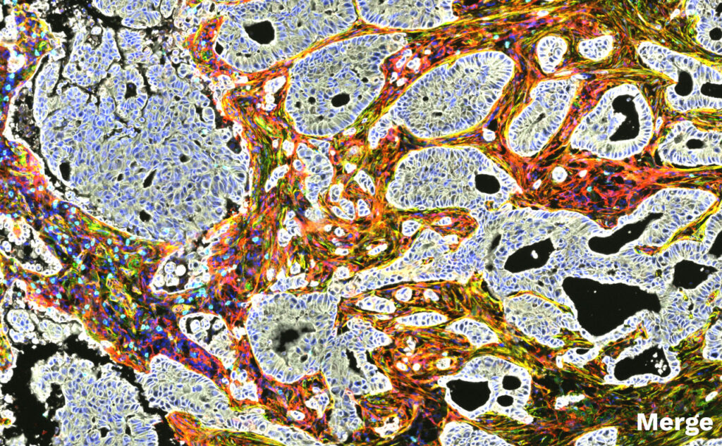 From cell phenotype to spatial relationships: multiplex digital pathology in NSCLC