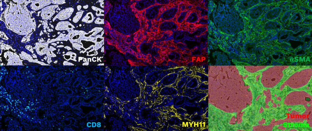 Compartment-aware analysis identifies distinct CAF phenotypes